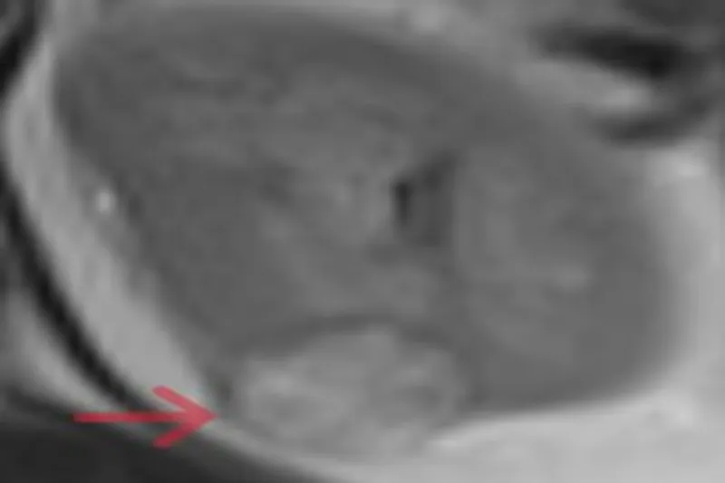 Laparoskopik Parsiyel Nefrektomi ile Ağrı